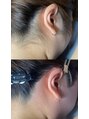 エヴァワックス 新宿店(Eva Wax) うなじもみあげbefore/after【全身脱毛/光脱毛/角質除去/鼻毛】