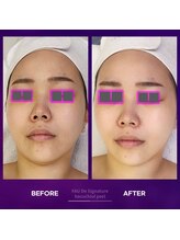 アムレット(Amourette)/FAUバクチオールピールで透明感