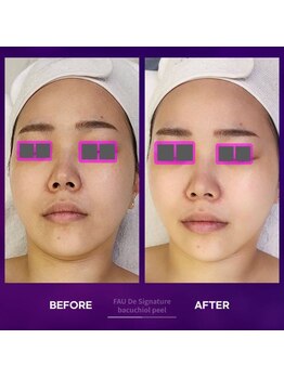 アムレット(Amourette)/FAUバクチオールピールで透明感