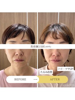 アボット(ABBOTT)/美容鍼15回 40代