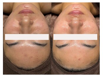 フェイスプラスリフ(FACE+RiF)/ニキビ、肌荒れ、毛穴、くすみ