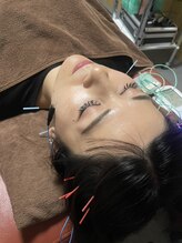 あらかき接骨院/【美容鍼】