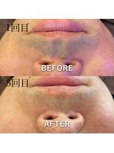 アルマース(Arumasu)/メンズひげ脱毛