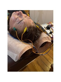 爽健美/電気を流す美容鍼