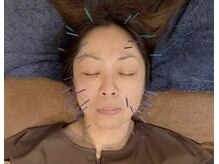 こじま 富雄団地接骨院/ヒト幹細胞美容鍼