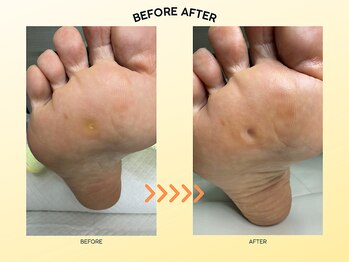 ドクターネイル爪革命 苫小牧店/魚の目・たこケア