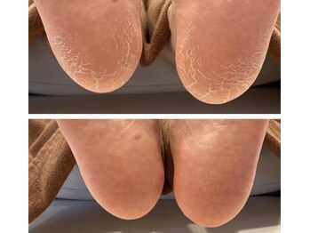 快歩堂フットケアセンター 日本橋館/ガサガサ踵ケア！！