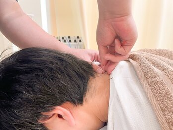 まえかわ鍼灸整骨院の写真/【慢性的な首肩のつらさや頭痛に】鍼+マッサージの同時施術が可能!状態に合わせて、効果にこだわりご提案☆