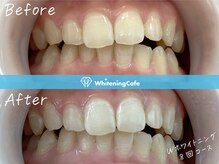 ホワイトニングカフェ 原宿店/◎歯のホワイトニング施術写真◎