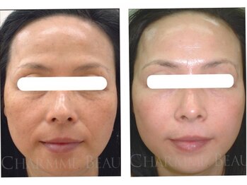 ココロ(Cocoro)の写真/微細針で真皮へ届けシミ,しわ,たるみ改善!高濃度グルタチオン還元酵素/ビタミンC誘導体/ヒアルロン酸で肌育