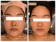 アセンド(ASCEND)の写真/小顔コルギを超える【韓国小顔矯正コルグン】で究極の輪郭造形骨格の歪みを改善しスッキリ小顔に◎