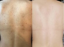 アイリープ(eyeleap)/☆剥離なしピーリング　背中