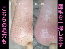 ティーツリー 名古屋 桜山(Tea Tree)/毛穴の黒ずみの正体は第２弾！