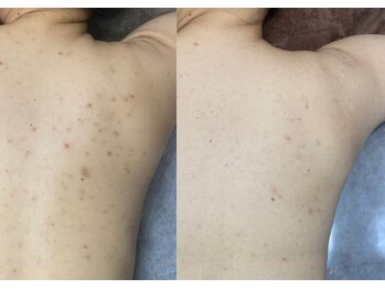 ラビエス(LAVIES)/[30代人気NO1極上の背中ハーブ