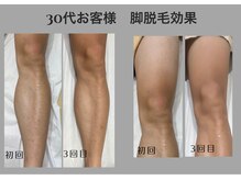 エピリス(EPILIS)/☆大人気脚脱毛お客様効果☆