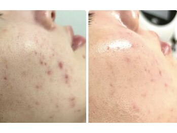 スムース イー(Smooth+E)/アゼライン酸ニキビケア　