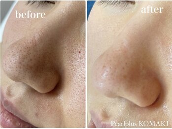 パールプラス 小牧店(Pearl plus)/BeforeAfter