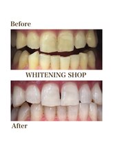 ホワイトニングショップ 銀座7丁目店(WHITENING SHOP)/Before After