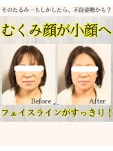 美容鍼＆首肩こり骨盤整体サロン ひふね/40代 美容鍼 Before/After