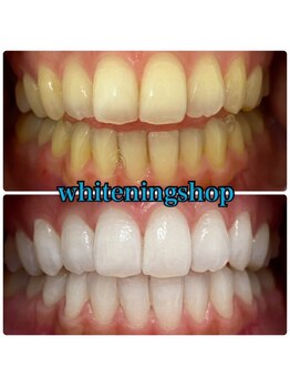 ホワイトニングショップ 武蔵小杉店/【BeforeAfter】9回 施術後比較
