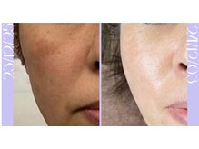 リラクゼーションサロン ラキ(laki)/スキンメイド/トロイアルケ