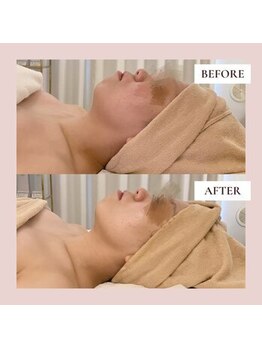 ミーティス/挙式前のむくみ取り&小顔ケア♪