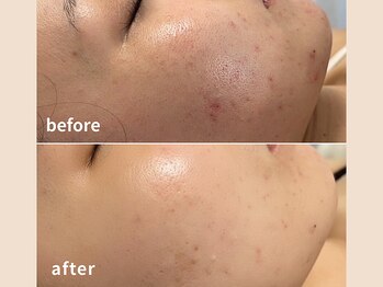 ソレイユ(Soleil)/ニキビ・肌荒れ