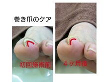 ドクターネイル爪革命 江戸川橋店/痛くなる前に早めのケアを。