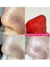 アイシェリー(eyecherie)/毛穴エクストラクション