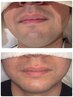【男性】乾燥肌や敏感肌→顔脱毛1回＋幹細胞導入パルス1回　￥8800