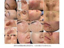 ルミナエステ(LUMINA ESTH)/症例