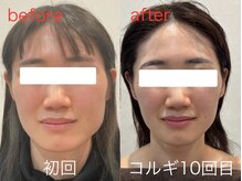 ビーキュート 学芸大学店(BE-CUTE)/Before/After　施術