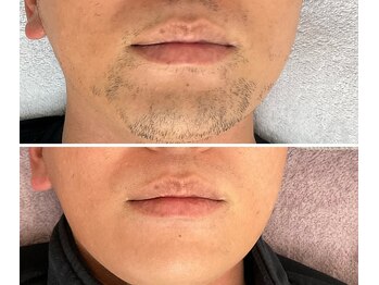 リノミラ(LINOMIRA)の写真/初回は50％オフ！抑毛効果も◎LED脱毛導入サロン★青ひげや剃り残し、ムダ毛が気になる方におすすめ！
