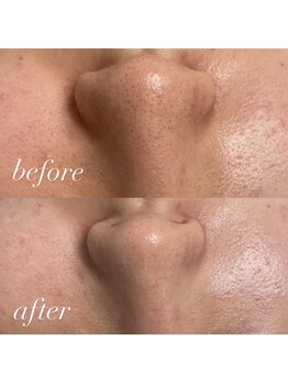 毛穴ケアをしたい