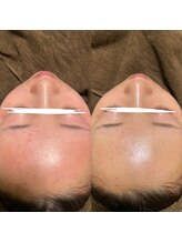 ナチュウル(Natulu)/シルク糸脱毛+ハーブピーリング