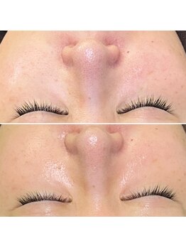 ソルニコン(Solnikon)/鼻・頬の毛穴撃退!