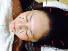 レメディ/再生美容鍼コース（ヒト幹導入）