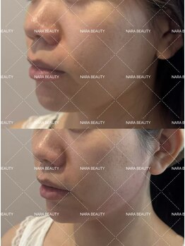 ナラビューティー(NARA BEAUTY)/韓国最新オンタリフト導入!