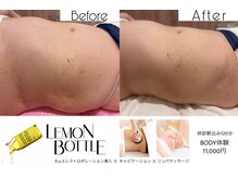 腹部はもちろん気になる部位、落ちにくい脂肪へアプローチ