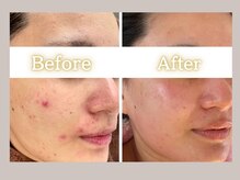 ハル(HARU.)/毛穴の開き/ニキビ改善