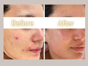 ハル(HARU.)/毛穴の開き/ニキビ改善