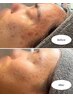 【セット割】毛穴洗浄×ニキビケアアンプル