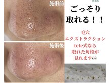 アイシェリー(eyecherie)/毛穴エクストラクション