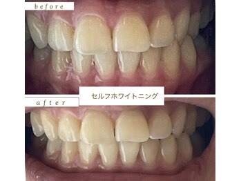 エスデザイン(es design)/セルフホワイトニング/谷山