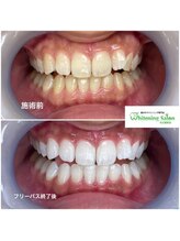 ホワイトニングサロン 名古屋駅店/【ホワイトニング施術例】