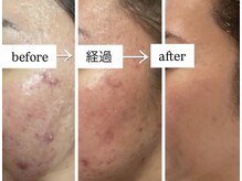 ビー ブルーム(B BLOOM)/【ニキビケア】繰り返さない肌へ