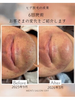 オフ(off)/ヒゲ脱毛
