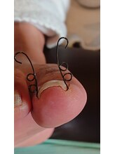 フットケアサロン ラビフット(Rabbi foot)/靴の圧迫で歩行時に爪が痛い