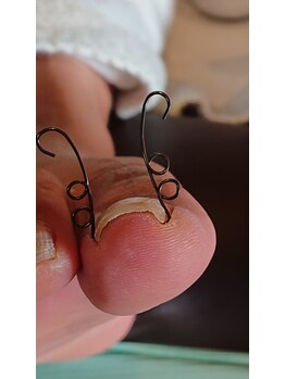 フットケアサロン ラビフット(Rabbi foot)/靴の圧迫で歩行時に爪が痛い
