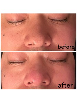 ウイユサロン(oeilsalon)/毛穴と角質ケア